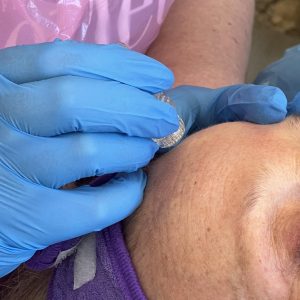 Hydrainfusion- Skin Needling