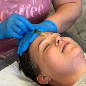 Nappage- Skin Needling